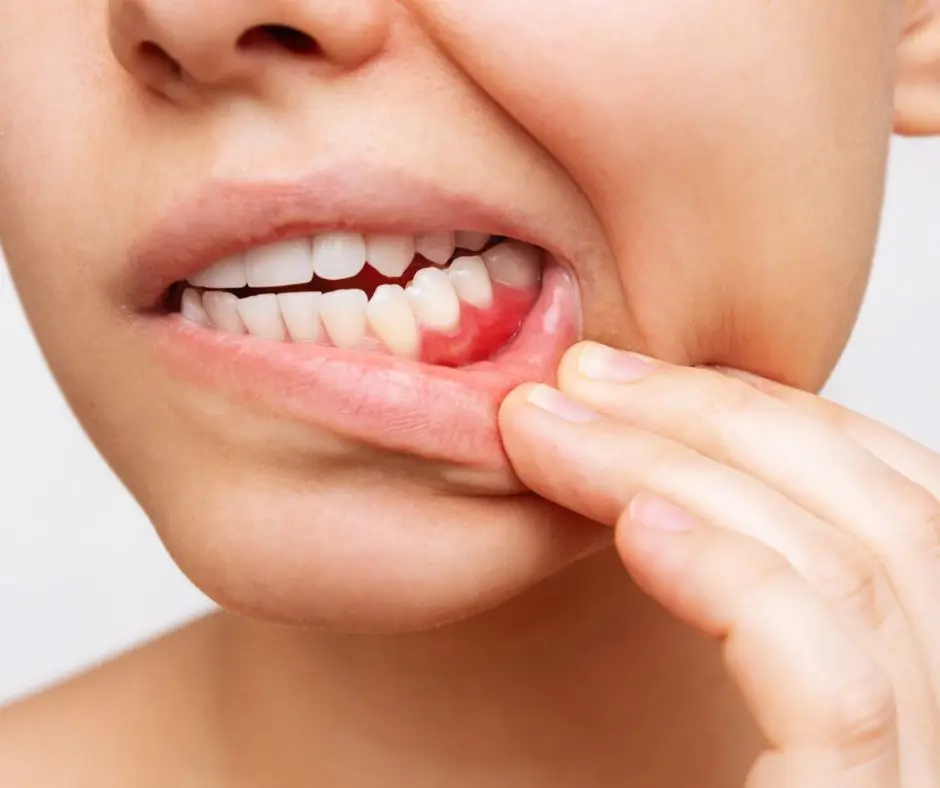 woman with gum disease